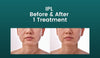 Woman's face before and after IPL treatment
