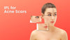 IPL for acne scars