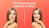 Girl's face before and after IPL photofacial treatment