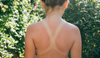 womans-back-with-summer-burn